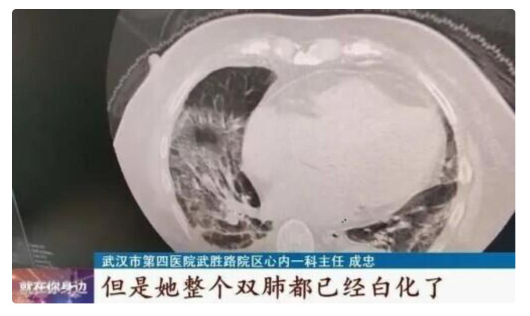 专家解释白肺是否会对肺部造成不可逆伤害.预防方法详细解说