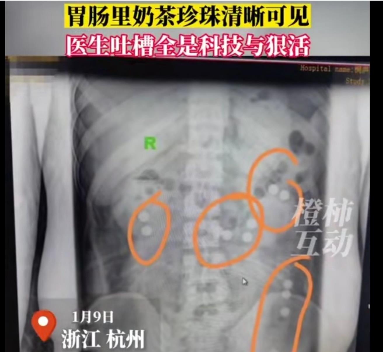 小伙腰痛到医院拍片做CT发现:胃肠里奶茶珍珠清晰可见呀