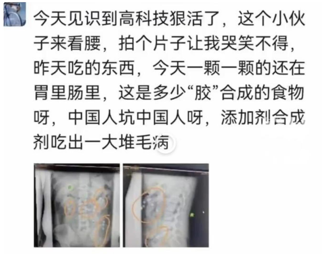 小伙腰痛到医院拍片做CT发现:胃肠里奶茶珍珠清晰可见呀