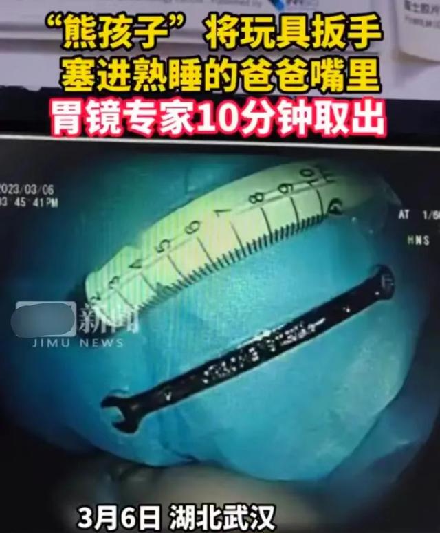 张嘴睡觉误吞20cm扳手尽不知道.
