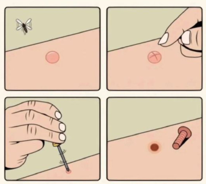 夏天被蚊子咬到正确的处理方式+防蚊小贴士