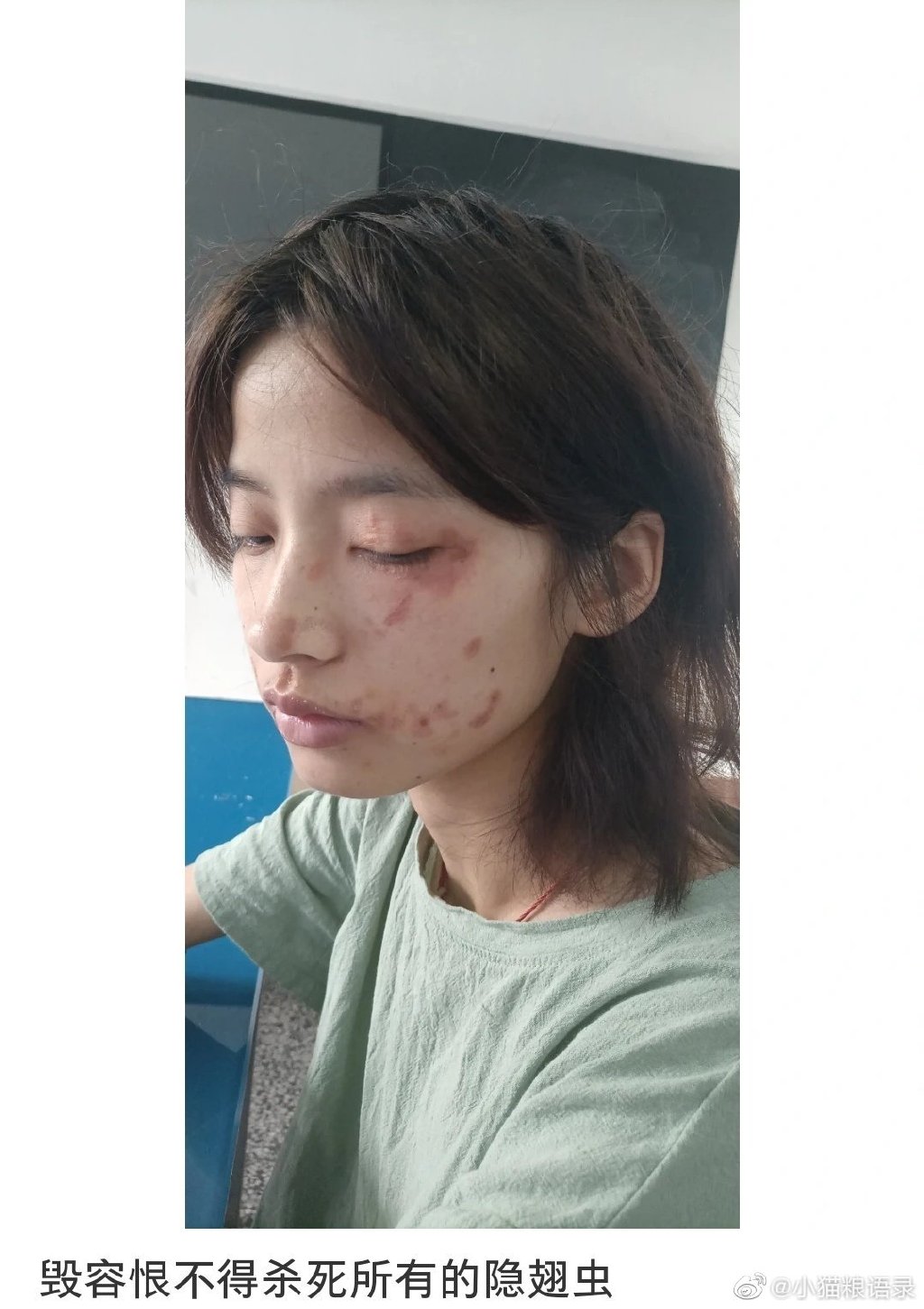 我的脸被隐翅虫毁容了之后，感觉生不如死了！