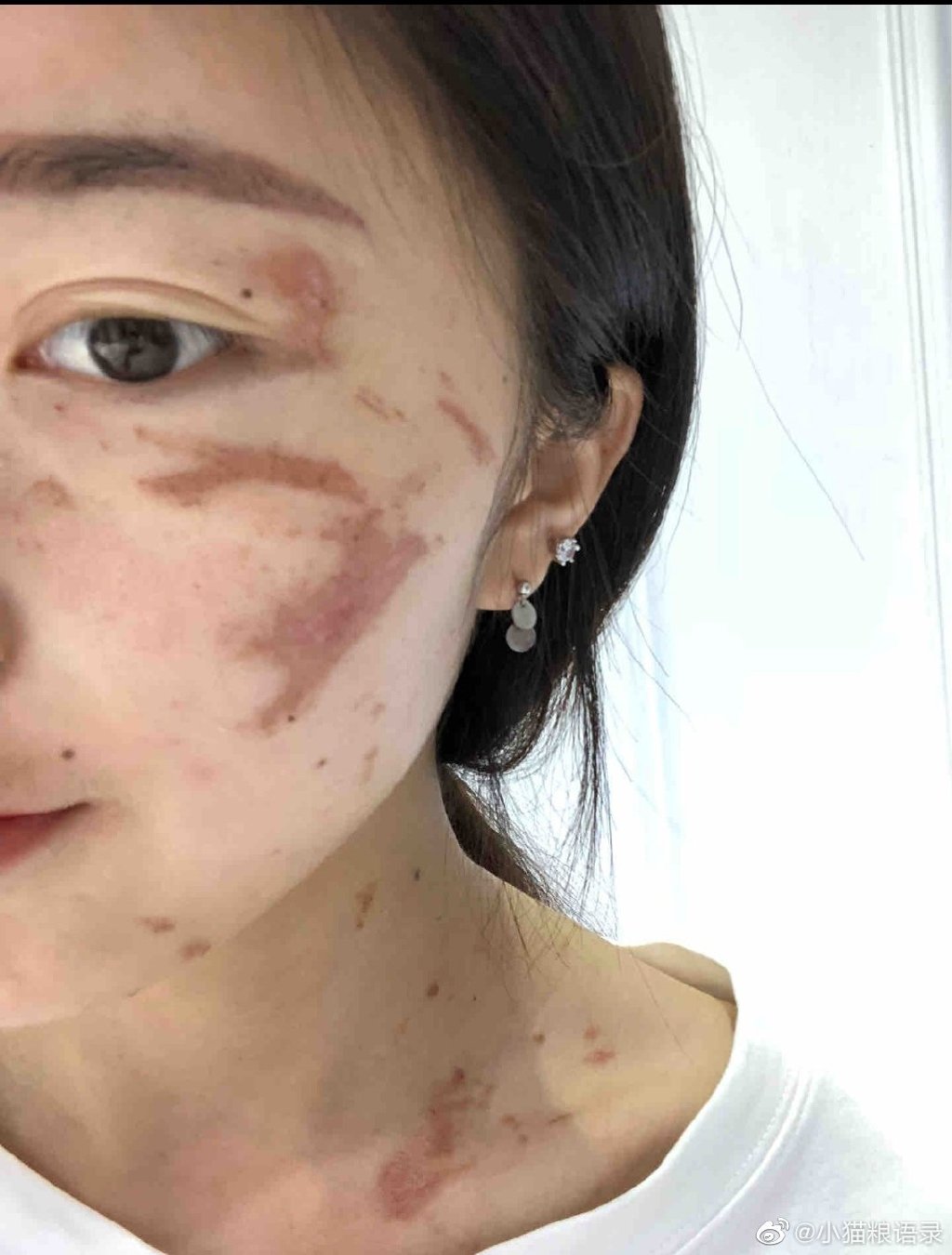 我的脸被隐翅虫毁容了之后，感觉生不如死了！