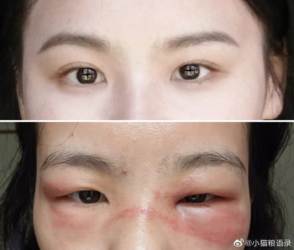 我的脸被隐翅虫毁容了之后，感觉生不如死了！