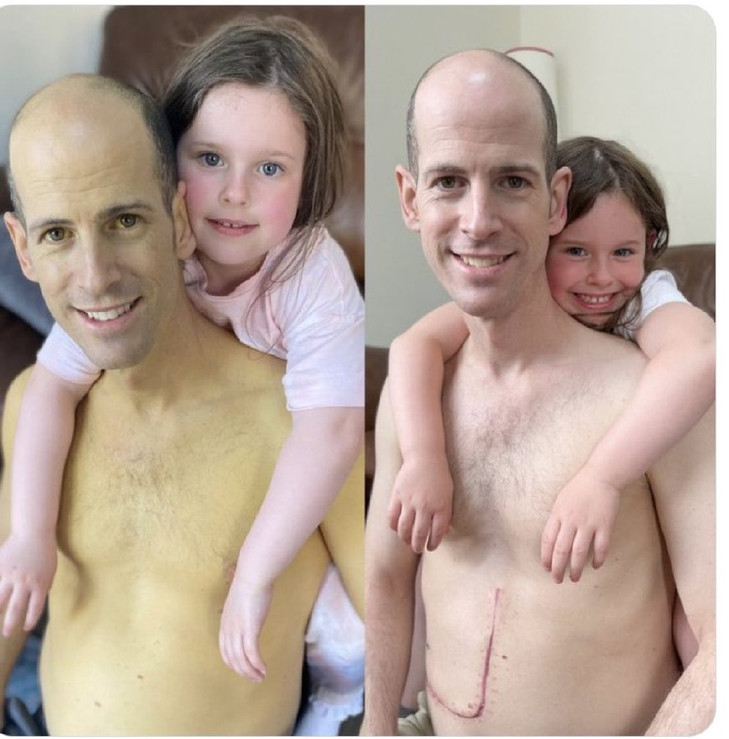 肝脏移植前后对皮肤的影响，肤色对比看完让人震惊