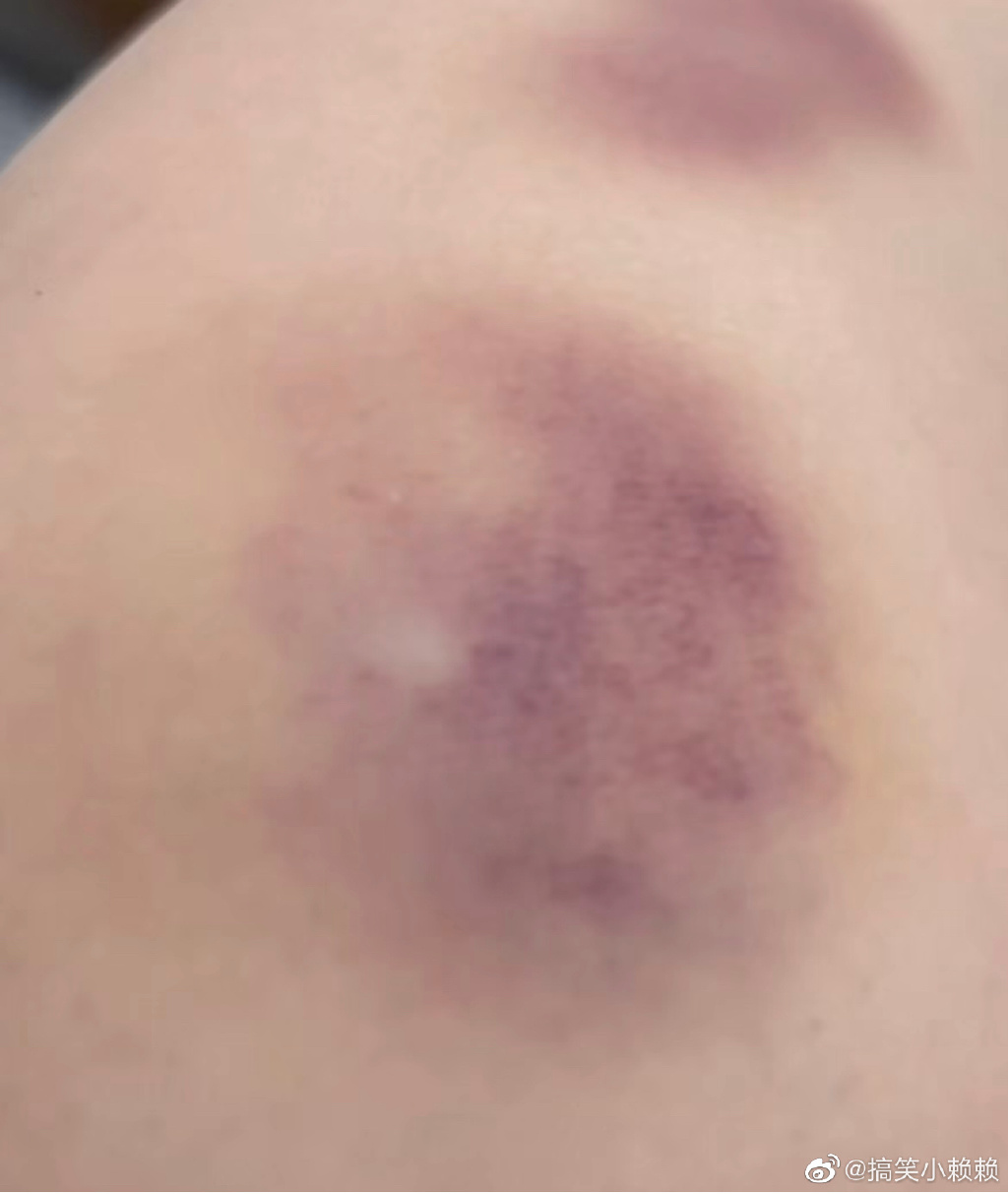 当蚊子吸了一口淤血后，神奇的化瘀活血功能出现了。