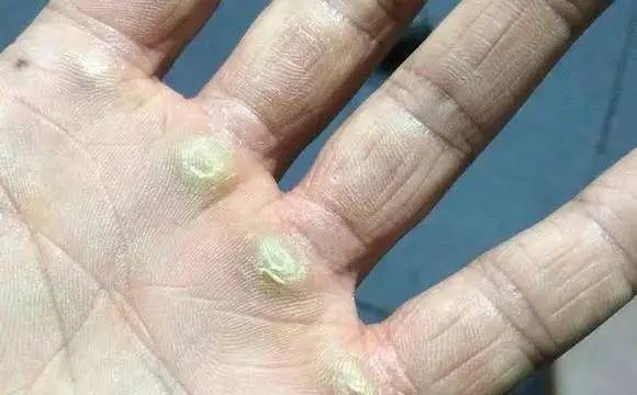 手上的茧子和鸡眼，这些东西都是怎么产生的？