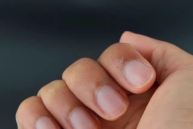 手上长了倒刺怎么办？能不能撕扯下来？虽然很痛但请坚持