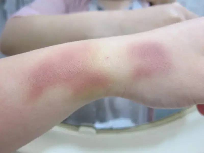 身上的乌青块揭秘：碰一下成画家，原来是血管秀逗了