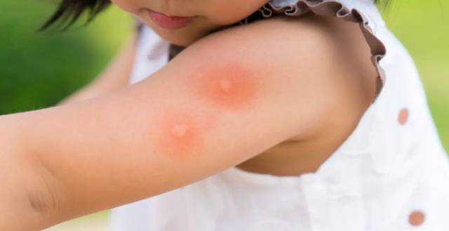 夏天的蚊子真的很讨嫌，它会把你咬出很多包！