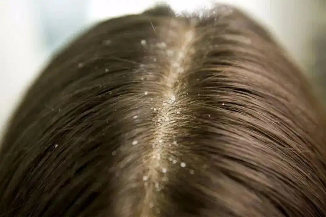 头皮上的小白雪：解密有些人的头皮屑为什么会如此多