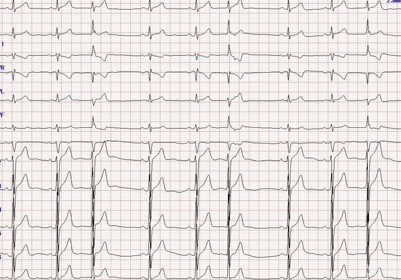 你懂心电图的波形条纹吗？它的原理和表达的意思各是什么