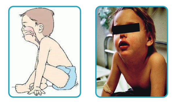 一旦出现这个姿势要立即就医.大人小孩都要警惕急性会厌炎