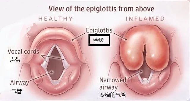 一旦出现这个姿势要立即就医.大人小孩都要警惕急性会厌炎