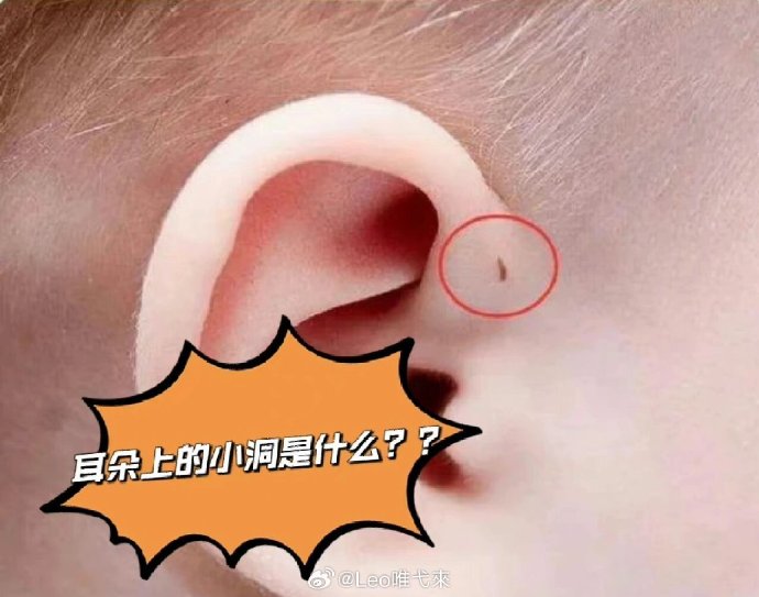 发现耳朵边上有个小孔的人还不少，原来是耳前瘘管症状