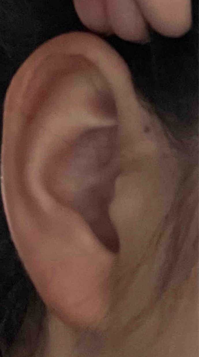 发现耳朵边上有个小孔的人还不少，原来是耳前瘘管症状