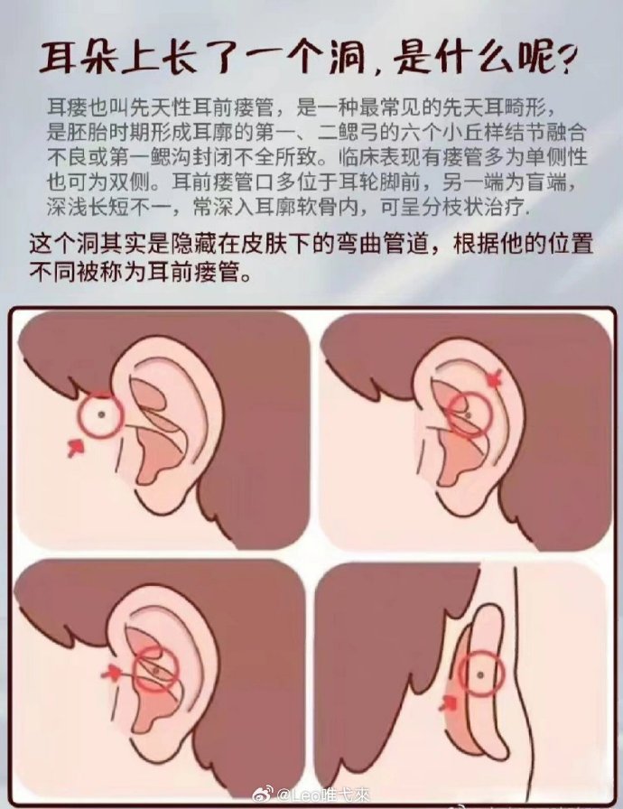 发现耳朵边上有个小孔的人还不少，原来是耳前瘘管症状