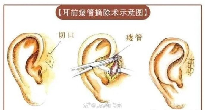 发现耳朵边上有个小孔的人还不少，原来是耳前瘘管症状