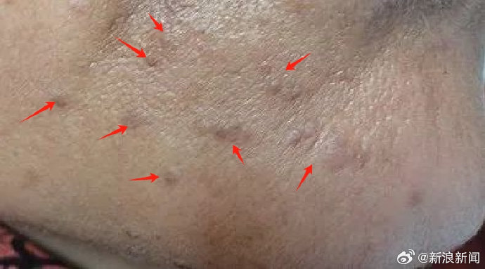 不要用手去抠身上这种小疙瘩，或是HPV感染后导致！