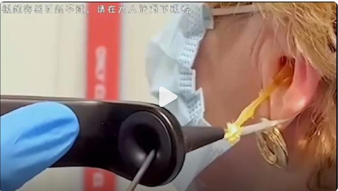 警惕耳内瘙痒背后的秘密：揭示潜在健康风险与对策