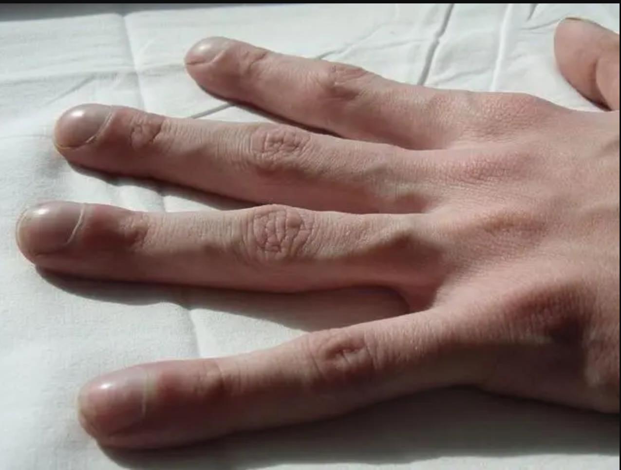 你有这种特殊形状的指甲吗？揭示杵状指背后的健康隐患