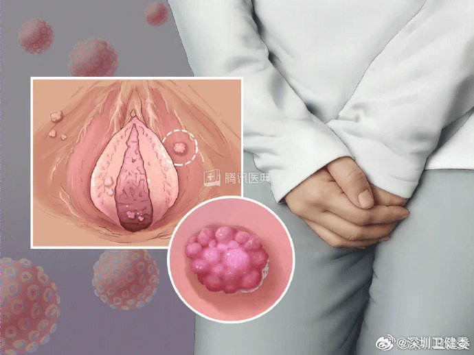 男性感染HPV后怎么看出来？大部分可能都是无症状