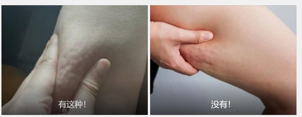 大腿上长了橘皮纹是什么引起的，绝不是因为胖