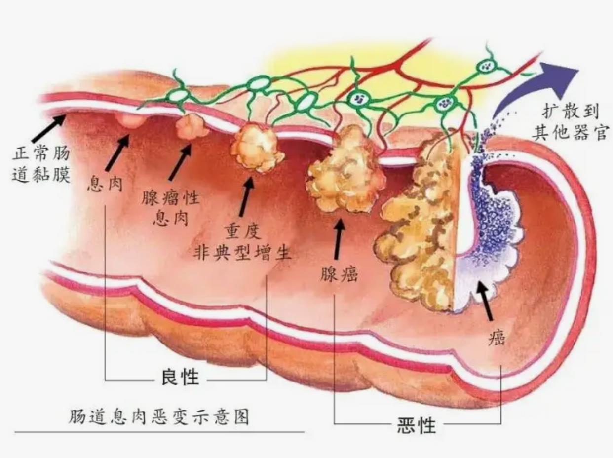 浙江一家8口确诊同种肠癌病：患罕见遗传病笼罩家族