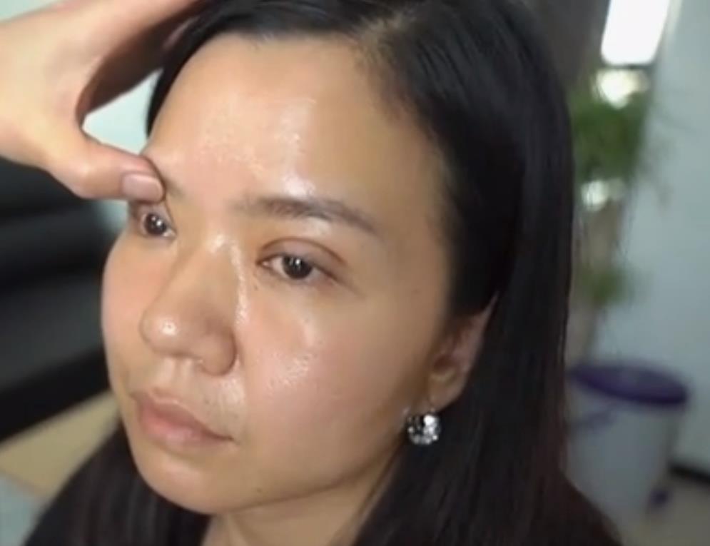 "悲伤蛙"双眼皮？女子花2万手术费换来的控诉维权路