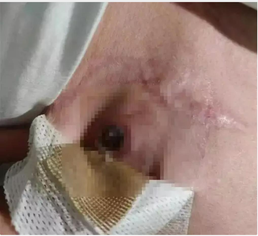 心脏起搏器惊险“出逃”跳出体外：只因老农民干活太猛