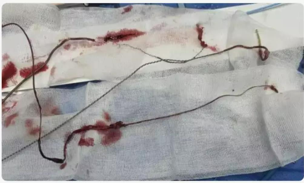 心脏起搏器惊险“出逃”跳出体外：只因老农民干活太猛