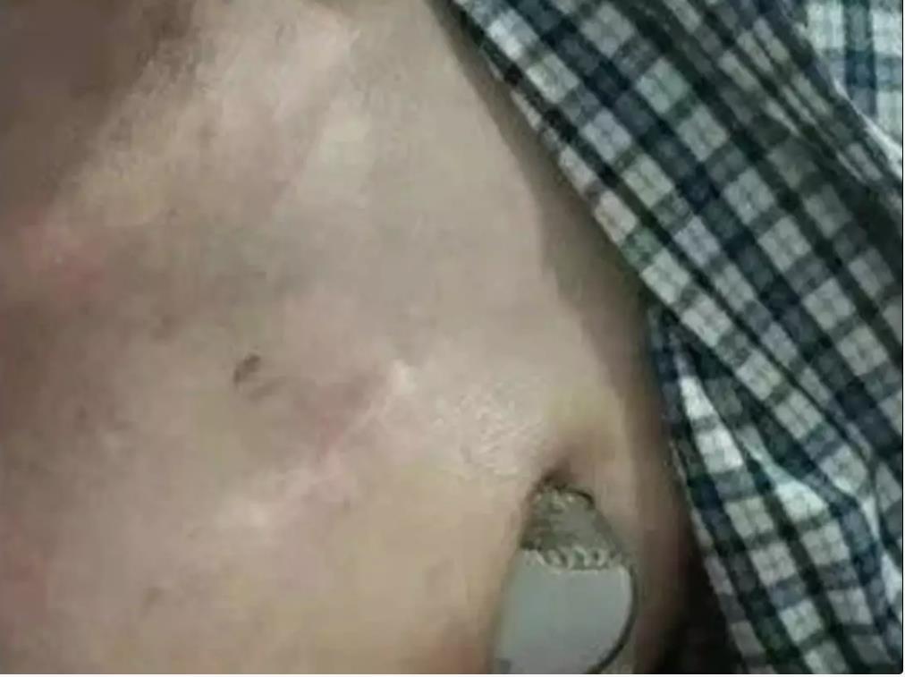 心脏起搏器惊险“出逃”跳出体外：只因老农民干活太猛