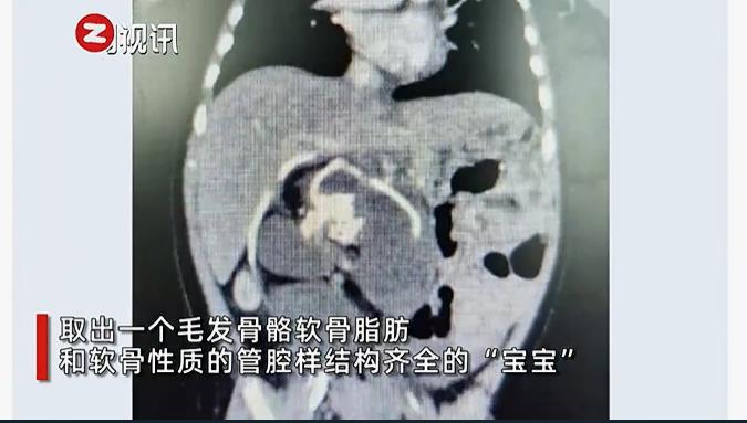 5个月女婴腹中取出“寄生胎”，人类史上罕见奇迹
