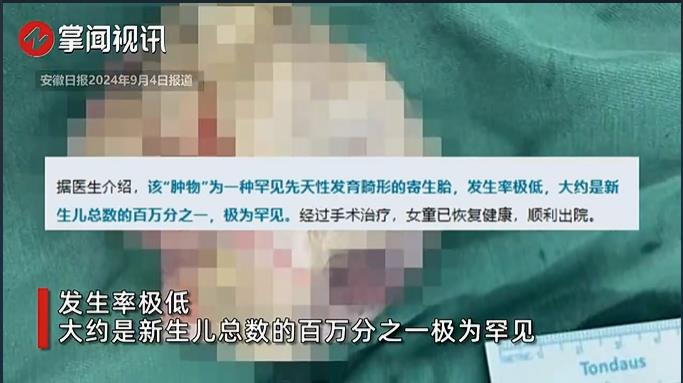 5个月女婴腹中取出“寄生胎”，人类史上罕见奇迹
