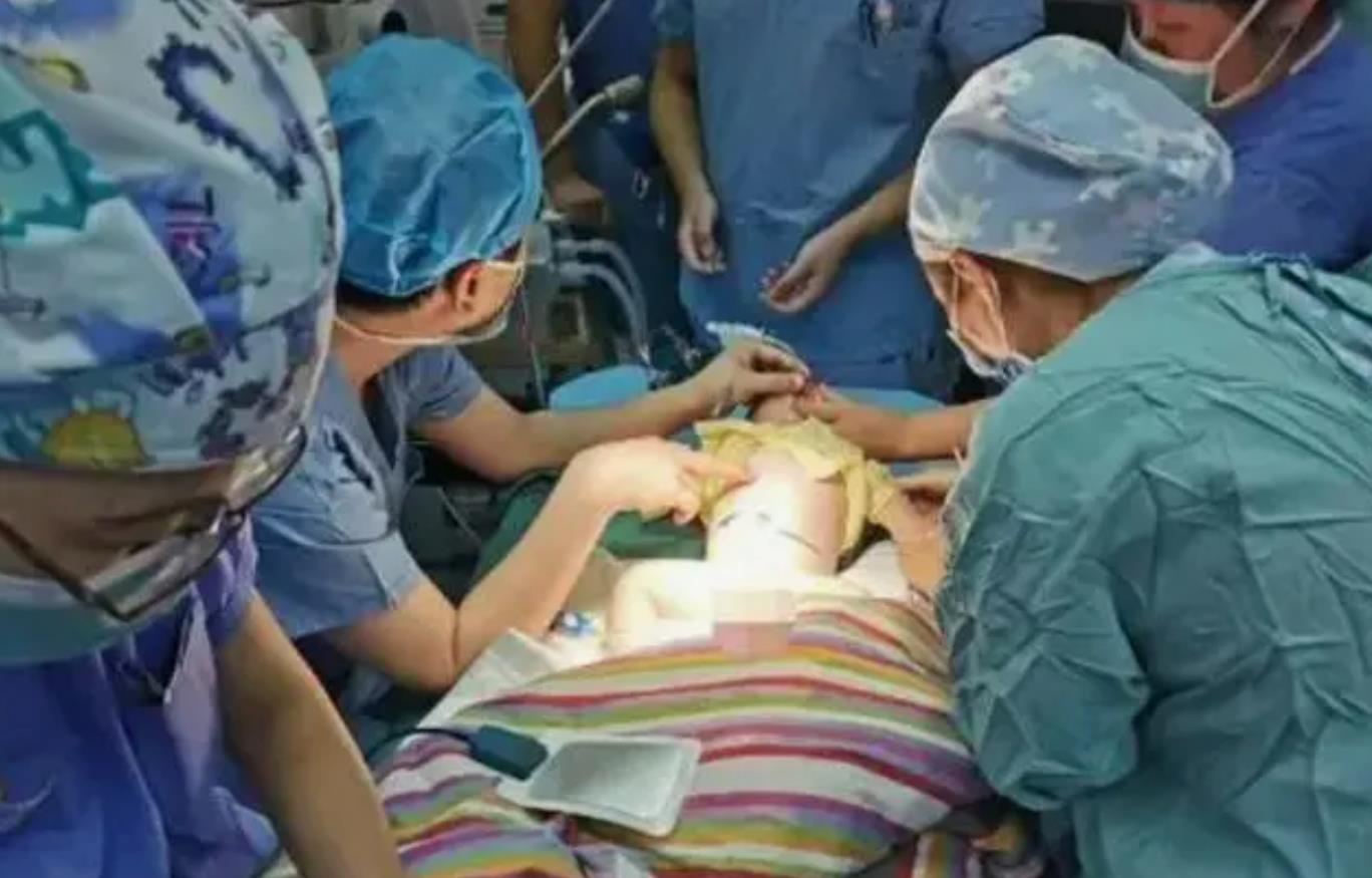 1岁男童腹腔惊现“宝宝”，罕见手术成功挽救生命