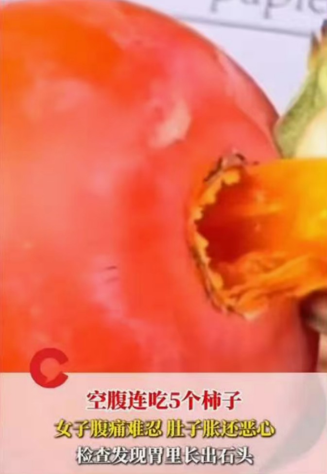 惊！湖南女子空腹狂炫5个柿子 竟在胃里“养”出结石